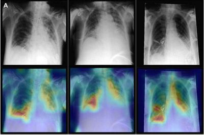 AI model combines imaging and patient data to improve chest X-ray diagnosis